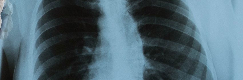 Pneumonia Detection From Chest X-Ray